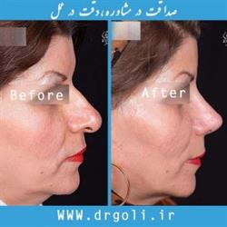 نازک کردن پوست بینی های گوشتی