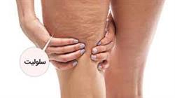 سلولیت چیست ؟