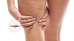 سلولیت چیست ؟
