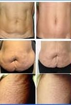 لاغری موضعی با ترکیب کربوکسی تراپی و مزوتراپی