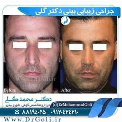 جراحی بینی طبیعی