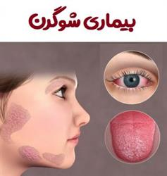 تغذیه در بیماری سندرم شوگرن و بیماری اسکلرودرمی