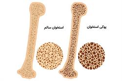 ویتامین D و کلسیم؛ دو رکن اصلی پیشگیری و مدیریت پوکی استخوان