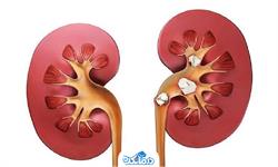 ​​​​تغذیه و پیشگیری از سنگ کلیه