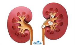 ​​​​تغذیه و پیشگیری از سنگ کلیه