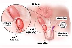 باد فتق