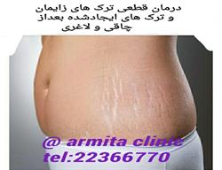 ترک های پوست را چگونه از بین ببریم؟؟