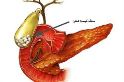 رژیم درمانی در سنگ کیسه صفرا و یک نمونه رژِیم