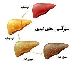 کبد چرب و ارتباط آن با چاقی
