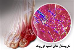 نقرس و تغذیه