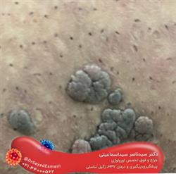 ویروس HPV یا پاپیلومای انسانی چیست؟ علائم، عوارض و درمان
