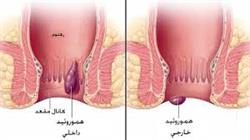 هموروئید چیست