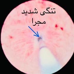 تنگی مجرا ، بیماری مزمن و دائمی ، ولی اگه درمان شوید آسیب اساسی ندارد؟