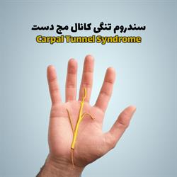 سندروم تنگی کانال مچ دست (Carpal Tunnel Syndrome)
