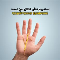 سندروم تنگی کانال مچ دست (Carpal Tunnel Syndrome)