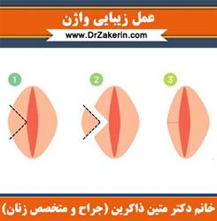 همه چیز درباره لابیاپلاستی و هزینه لابیاپلاستی (عمل زیبایی واژن)